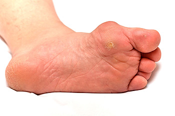 Can you get gout 2025 in side of foot