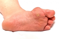 What to Do About a Corn on the Pinky Toe?