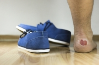 What to Do About Blood Blisters
