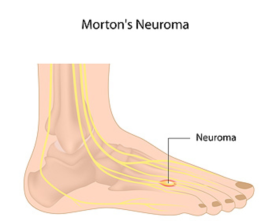 Best running shoes hot sale for morton's neuroma 219